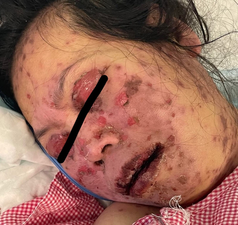 Saudi Arabia 49 yo Woman develops Skin-Rotting disorder 1 Week after Fay Sir sting 2 D2WJaol