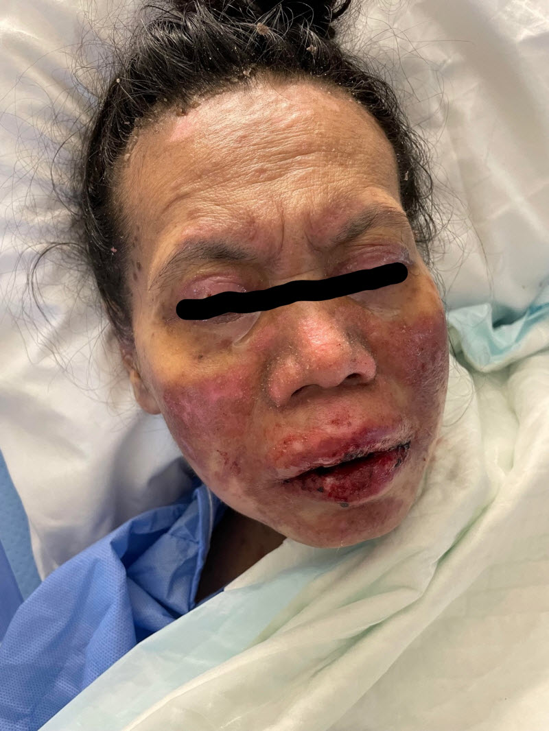 Saudi Arabia 49 yo Woman develops Skin-Rotting disorder 1 Week after Fay Sir sting 3 LO6BG2j