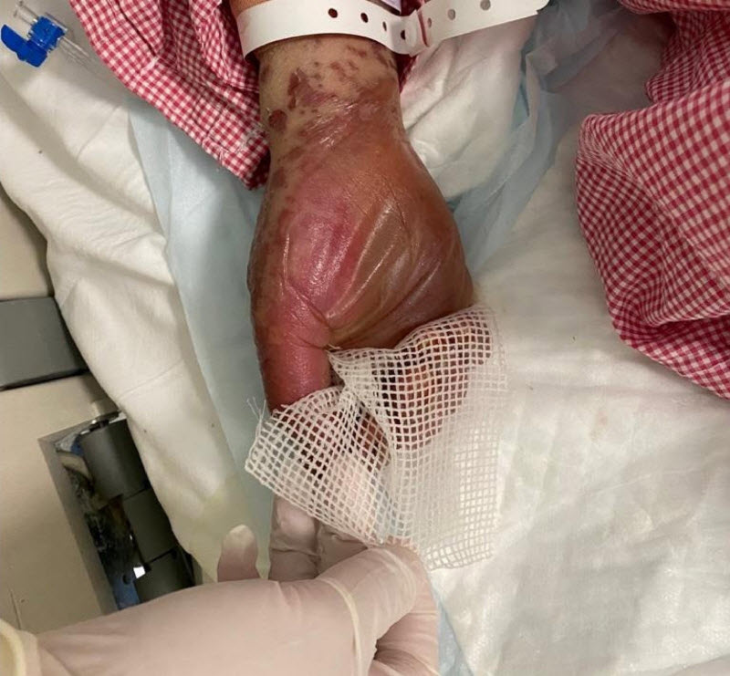 Saudi Arabia 49 yo Woman develops Skin-Rotting disorder 1 Week after Fay Sir sting 7 N77vsl7