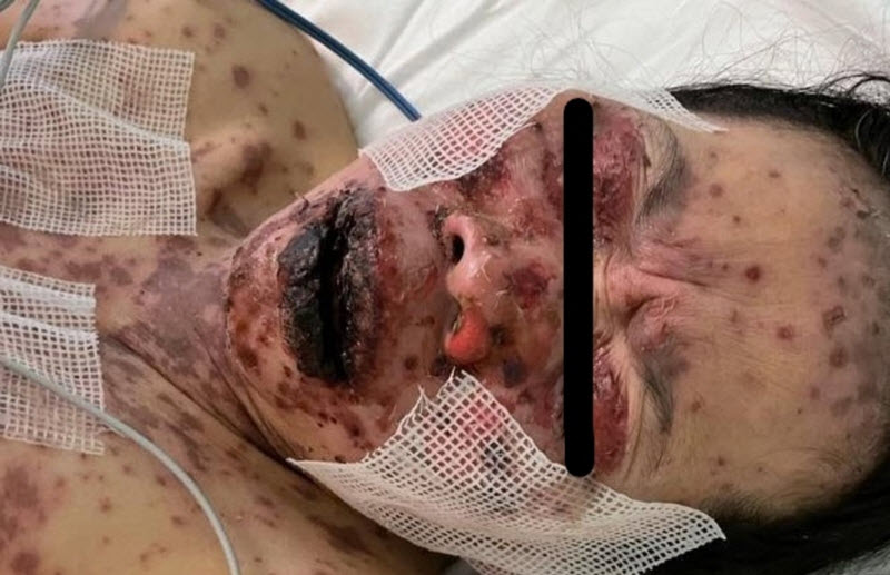 Saudi Arabia 49 yo Woman develops Skin-Rotting disorder 1 Week after Fay Sir sting 1