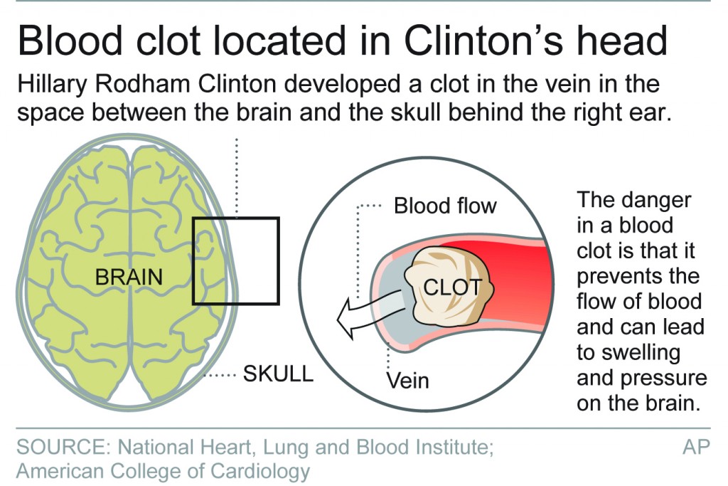 Hillary Clinton “Heart Failure Event” Warned Just Months Away 2 hhhp1