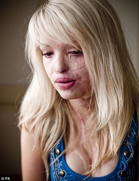 British model Katie Piper attacked by her savage boyfriend with acid on her face 7 article 1221077 06DF02EB000005DC