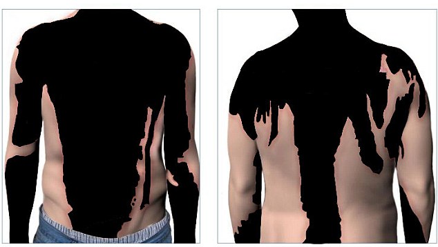 Sulphuric acid attacker who left man looking like 'zombie' facing jail 3 Severe: Awais Akram sustained 47 per cent burns to his body during the attack. 'I started burning, my whole body started to burn,' he told the court