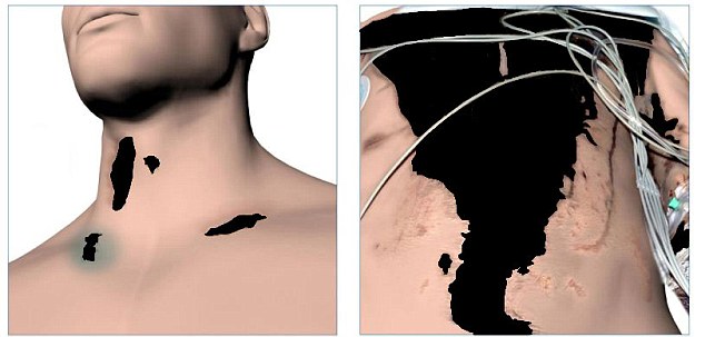 Sulphuric acid attacker who left man looking like 'zombie' facing jail 4 Awais Akram's neck, left, and torso were left badly burned after the attack