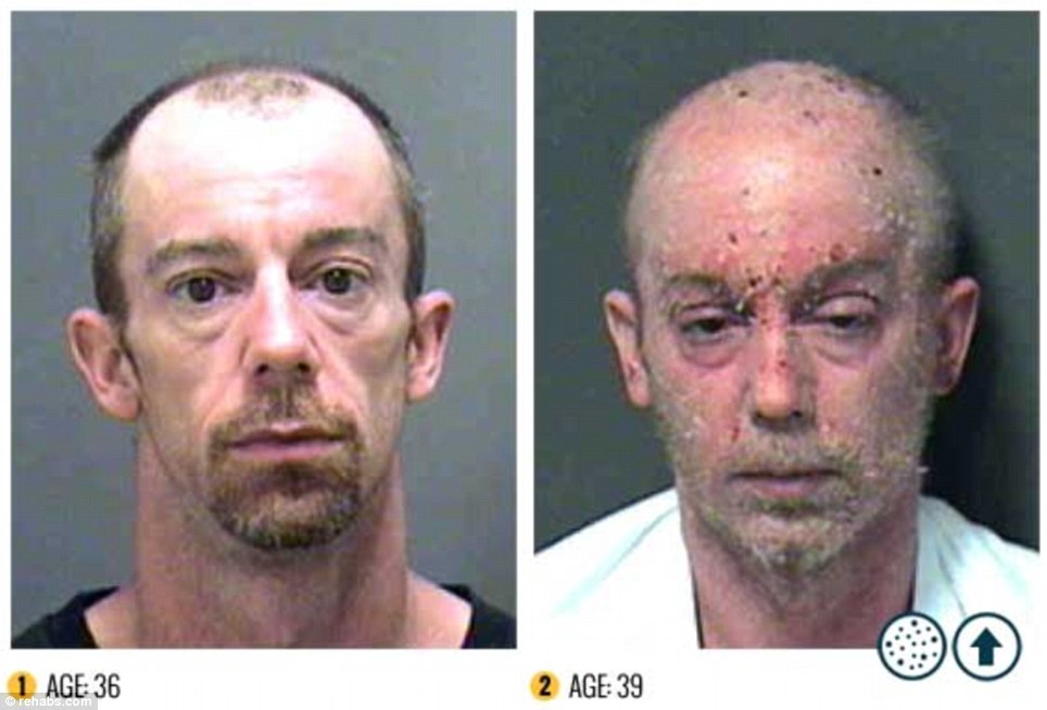 Shocking photo gallery of Meth drug addicts and its side effects 3 article 0 16619A60000005DC