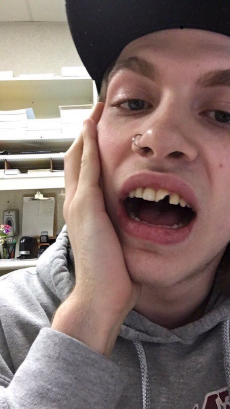 Kid Gets Tooth Knocked Out for Wearing Trump T-Shirt 2 tooth knocked out trump