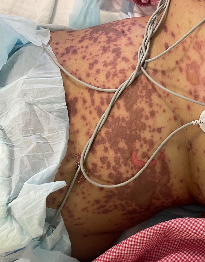 Saudi Arabia 49 yo Woman develops Skin-Rotting disorder 1 Week after Fay Sir sting 5 rc9pzTN