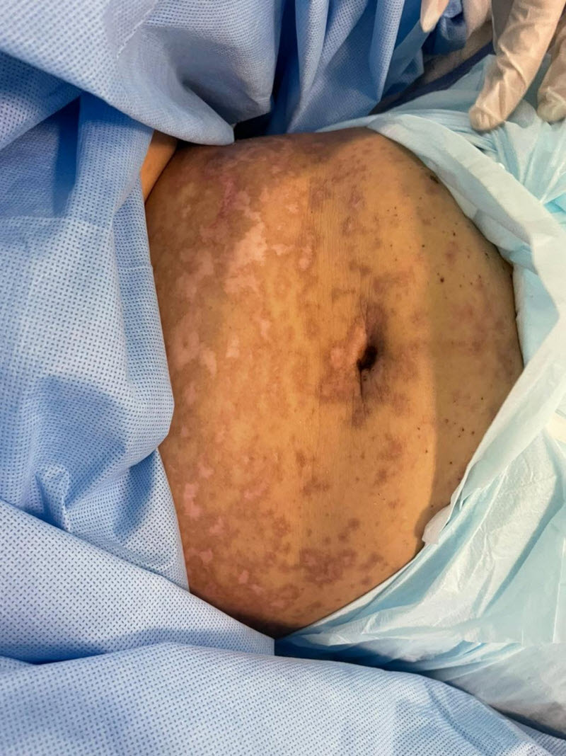Saudi Arabia 49 yo Woman develops Skin-Rotting disorder 1 Week after Fay Sir sting 6 tUiX1DH