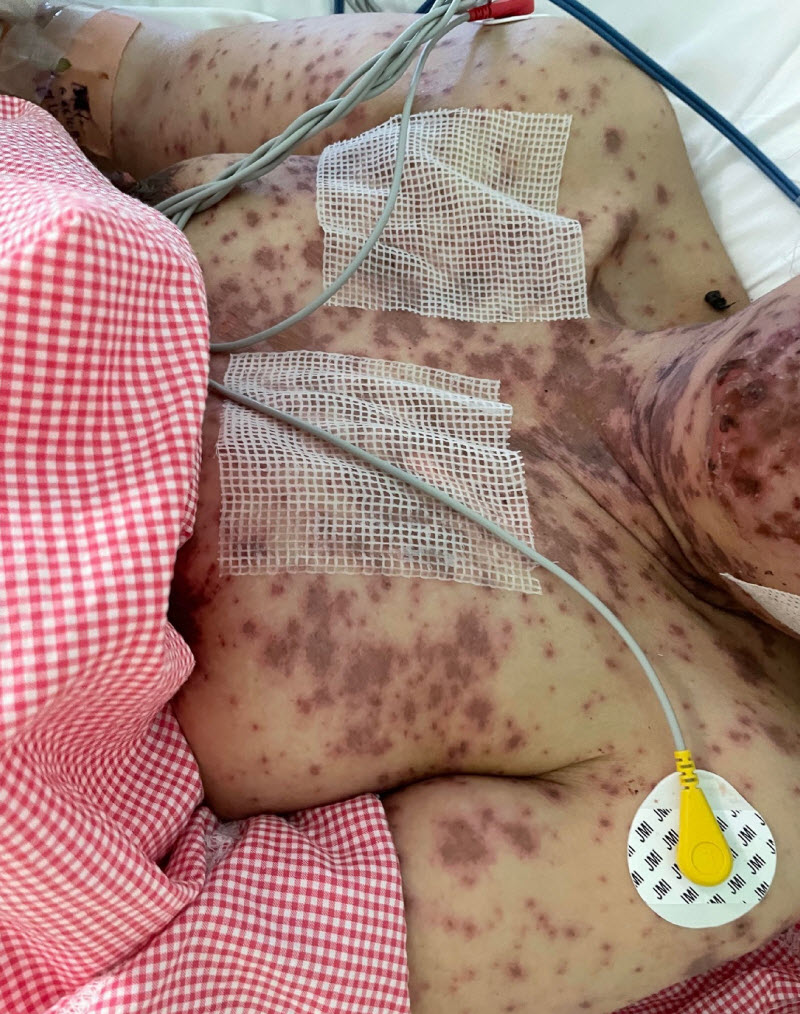 Saudi Arabia 49 yo Woman develops Skin-Rotting disorder 1 Week after Fay Sir sting 4 tiYVTPY